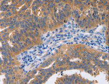 NBEA / Neurobeachin Antibody - Immunohistochemistry of paraffin-embedded Human cervical cancer using NBEA Polyclonal Antibody at dilution of 1:60.