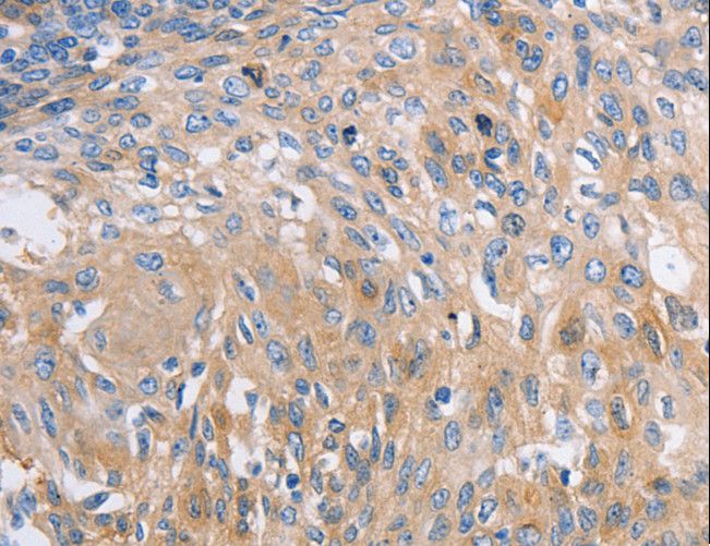 NBEA / Neurobeachin Antibody - Immunohistochemistry of paraffin-embedded Human cervical cancer using NBEA Polyclonal Antibody at dilution of 1:60.