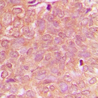 NBEAL1 Antibody - Immunohistochemical analysis of NBEAL1 staining in human breast cancer formalin fixed paraffin embedded tissue section. The section was pre-treated using heat mediated antigen retrieval with sodium citrate buffer (pH 6.0). The section was then incubated with the antibody at room temperature and detected using an HRP polymer system. DAB was used as the chromogen. The section was then counterstained with hematoxylin and mounted with DPX.