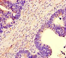 NBEAL2 Antibody - Immunohistochemistry of paraffin-embedded human ovarian cancer at dilution of 1:100