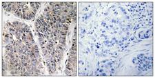 NBL1 / DAN Antibody - Immunohistochemistry analysis of paraffin-embedded human lung carcinoma tissue, using NBL1 Antibody. The picture on the right is blocked with the synthesized peptide.