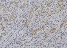 NBL1 / DAN Antibody - 1:100 staining human lung carcinoma tissue by IHC-P. The sample was formaldehyde fixed and a heat mediated antigen retrieval step in citrate buffer was performed. The sample was then blocked and incubated with the antibody for 1.5 hours at 22°C. An HRP conjugated goat anti-rabbit antibody was used as the secondary.