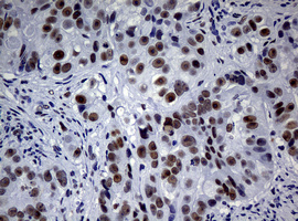 NBN / Nibrin Antibody - IHC of paraffin-embedded Adenocarcinoma of Human colon tissue using anti-NBN mouse monoclonal antibody.