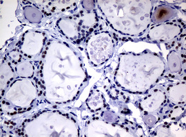 NBN / Nibrin Antibody - IHC of paraffin-embedded Human thyroid tissue using anti-NBN mouse monoclonal antibody.