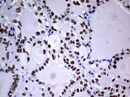 NBN / Nibrin Antibody - IHC of paraffin-embedded Carcinoma of Human thyroid tissue using anti-NBN mouse monoclonal antibody.