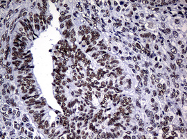 NBN / Nibrin Antibody - IHC of paraffin-embedded Adenocarcinoma of Human endometrium tissue using anti-NBN mouse monoclonal antibody.