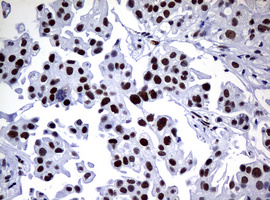 NBN / Nibrin Antibody - IHC of paraffin-embedded Carcinoma of Human bladder tissue using anti-NBN mouse monoclonal antibody.