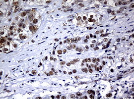 NBN / Nibrin Antibody - IHC of paraffin-embedded Adenocarcinoma of Human colon tissue using anti-NBN mouse monoclonal antibody.