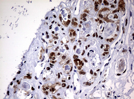NBN / Nibrin Antibody - IHC of paraffin-embedded Carcinoma of Human thyroid tissue using anti-NBN mouse monoclonal antibody.