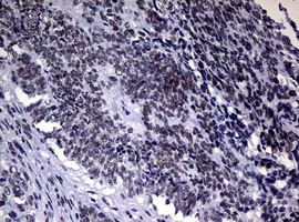 NBN / Nibrin Antibody - IHC of paraffin-embedded Adenocarcinoma of Human endometrium tissue using anti-NBN mouse monoclonal antibody.