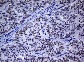 NBN / Nibrin Antibody - IHC of paraffin-embedded Adenocarcinoma of Human ovary tissue using anti-NBN mouse monoclonal antibody.