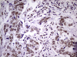 NBN / Nibrin Antibody - IHC of paraffin-embedded Adenocarcinoma of Human breast tissue using anti-NBN mouse monoclonal antibody.