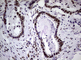 NBN / Nibrin Antibody - IHC of paraffin-embedded Adenocarcinoma of Human colon tissue using anti-NBN mouse monoclonal antibody.