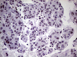 NBN / Nibrin Antibody - IHC of paraffin-embedded Carcinoma of Human liver tissue using anti-NBN mouse monoclonal antibody.