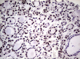 NBN / Nibrin Antibody - IHC of paraffin-embedded Carcinoma of Human thyroid tissue using anti-NBN mouse monoclonal antibody.