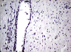 NBN / Nibrin Antibody - IHC of paraffin-embedded Carcinoma of Human prostate tissue using anti-NBN mouse monoclonal antibody.