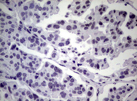 NBN / Nibrin Antibody - IHC of paraffin-embedded Carcinoma of Human bladder tissue using anti-NBN mouse monoclonal antibody.