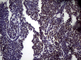 NBN / Nibrin Antibody - IHC of paraffin-embedded Human lymphoma tissue using anti-NBN mouse monoclonal antibody.