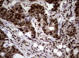 NBN / Nibrin Antibody - IHC of paraffin-embedded Adenocarcinoma of Human breast tissue using anti-NBN mouse monoclonal antibody.