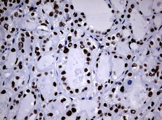 NBN / Nibrin Antibody - Immunohistochemical staining of paraffin-embedded Carcinoma of Human thyroid tissue using anti-NBN mouse monoclonal antibody.  heat-induced epitope retrieval by 10mM citric buffer, pH6.0, 120C for 3min)
