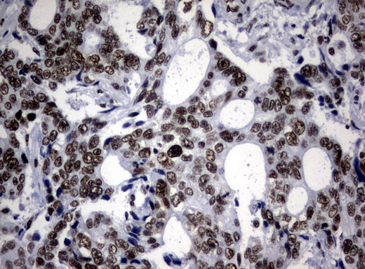 NBN / Nibrin Antibody - Immunohistochemical staining of paraffin-embedded Adenocarcinoma of Human breast tissue using anti-NBN mouse monoclonal antibody.  heat-induced epitope retrieval by 10mM citric buffer, pH6.0, 120C for 3min)