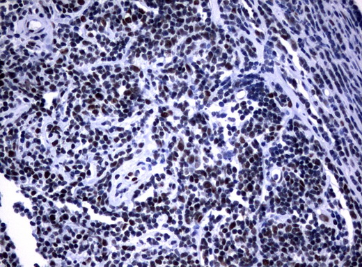 NBN / Nibrin Antibody - Immunohistochemical staining of paraffin-embedded Human lymphoma tissue using anti-NBN mouse monoclonal antibody.  heat-induced epitope retrieval by 10mM citric buffer, pH6.0, 120C for 3min)