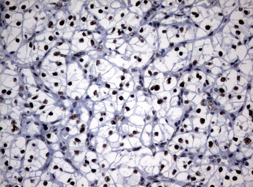 NBN / Nibrin Antibody - Immunohistochemical staining of paraffin-embedded Carcinoma of Human kidney tissue using anti-NBN mouse monoclonal antibody.  heat-induced epitope retrieval by 10mM citric buffer, pH6.0, 120C for 3min)