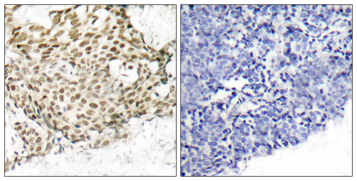 NBN / Nibrin Antibody - Immunohistochemistry analysis of paraffin-embedded human breast carcinoma tissue, using p95/NBS1 Antibody. The picture on the right is blocked with the synthesized peptide.
