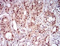 NBN / Nibrin Antibody - Immunohistochemistry: NBS1 Antibody (7E4A2) - Immunohistochemical analysis of paraffin-embedded cervical cancer tissues using NBN mouse mAb with DAB staining.