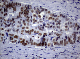 NBN / Nibrin Antibody - IHC of paraffin-embedded Adenocarcinoma of Human colon tissue using anti-NBN mouse monoclonal antibody.