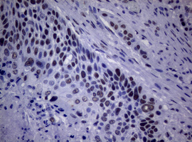 NBN / Nibrin Antibody - IHC of paraffin-embedded Carcinoma of Human lung tissue using anti-NBN mouse monoclonal antibody.