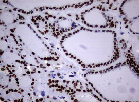 NBN / Nibrin Antibody - IHC of paraffin-embedded Carcinoma of Human thyroid tissue using anti-NBN mouse monoclonal antibody.