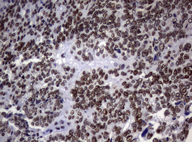 NBN / Nibrin Antibody - IHC of paraffin-embedded Adenocarcinoma of Human endometrium tissue using anti-NBN mouse monoclonal antibody.