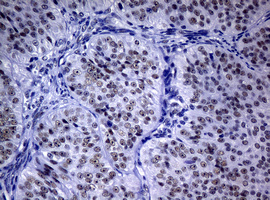 NBN / Nibrin Antibody - IHC of paraffin-embedded Adenocarcinoma of Human ovary tissue using anti-NBN mouse monoclonal antibody. (Heat-induced epitope retrieval by 10mM citric buffer, pH6.0, 120°C for 3min).
