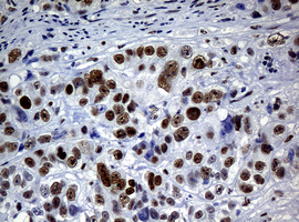 NBN / Nibrin Antibody - IHC of paraffin-embedded Adenocarcinoma of Human colon tissue using anti-NBN mouse monoclonal antibody.