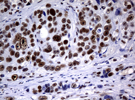 NBN / Nibrin Antibody - IHC of paraffin-embedded Adenocarcinoma of Human colon tissue using anti-NBN mouse monoclonal antibody.