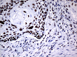 NBN / Nibrin Antibody - IHC of paraffin-embedded Carcinoma of Human lung tissue using anti-NBN mouse monoclonal antibody.