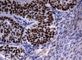 NBN / Nibrin Antibody - IHC of paraffin-embedded Adenocarcinoma of Human ovary tissue using anti-NBN mouse monoclonal antibody.