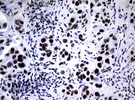 NBN / Nibrin Antibody - IHC of paraffin-embedded Carcinoma of Human bladder tissue using anti-NBN mouse monoclonal antibody.