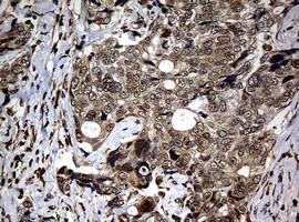 NBN / Nibrin Antibody - IHC of paraffin-embedded Adenocarcinoma of Human breast tissue using anti-NBN mouse monoclonal antibody.