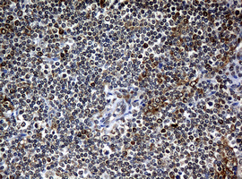 NBN / Nibrin Antibody - IHC of paraffin-embedded Human lymphoma tissue using anti-NBN mouse monoclonal antibody.