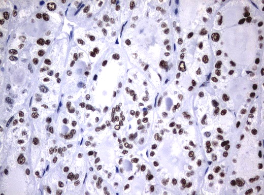 NBN / Nibrin Antibody - Immunohistochemical staining of paraffin-embedded Carcinoma of Human thyroid tissue using anti-NBN mouse monoclonal antibody.  heat-induced epitope retrieval by 10mM citric buffer, pH6.0, 120C for 3min)