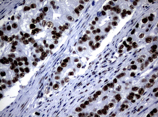 NBN / Nibrin Antibody - Immunohistochemical staining of paraffin-embedded Adenocarcinoma of Human colon tissue using anti-NBN mouse monoclonal antibody.  heat-induced epitope retrieval by 10mM citric buffer, pH6.0, 120C for 3min)