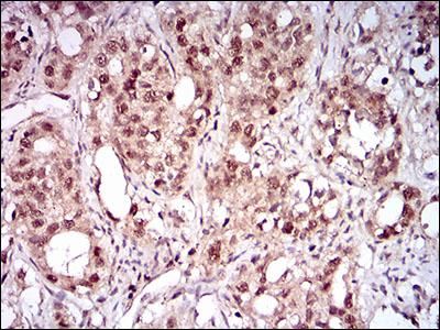NBN / Nibrin Antibody - IHC of paraffin-embedded cervical cancer tissues using NBN mouse monoclonal antibody with DAB staining.