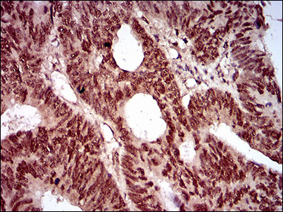 NBN / Nibrin Antibody - IHC of paraffin-embedded rectum cancer tissues using NBN mouse monoclonal antibody with DAB staining.