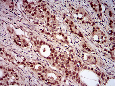 NBN / Nibrin Antibody - IHC of paraffin-embedded cervical cancer tissues using NBN mouse monoclonal antibody with DAB staining.