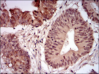 NBN / Nibrin Antibody - IHC of paraffin-embedded colon cancer tissues using NBN mouse monoclonal antibody with DAB staining.