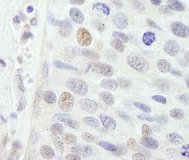 NBN / Nibrin Antibody - Detection of Human NBS1 by Immunohistochemistry. Sample: FFPE section of human breast carcinoma. Antibody: Affinity purified rabbit anti-NBS1 used at a dilution of 1:250.