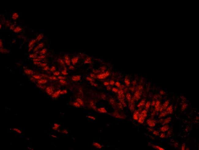 NBN / Nibrin Antibody - Detection of Human NBS1 by Immunofluorescence. Sample: FFPE section of human ovarian carcinoma. Antibody: Affinity purified rabbit anti-NBS1 used at a dilution of 1:250. Detection: Red-fluorescent goat anti-rabbit IgG highly cross-adsorbed Antibody used at a dilution of 1:100.