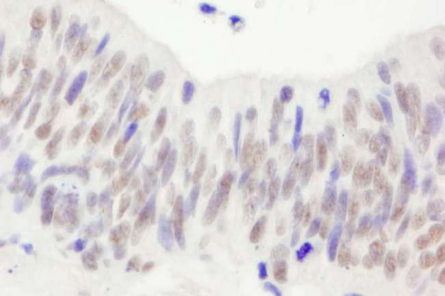NBN / Nibrin Antibody - Detection of Human NBS1 by Immunohistochemistry. Sample: FFPE section of human ovarian carcinoma. Antibody: Affinity purified rabbit anti-NBS1 used at a dilution of 1:200 (1 Detection: DAB.
